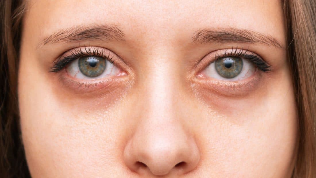 reduce dark circles and puffiness under your eyes