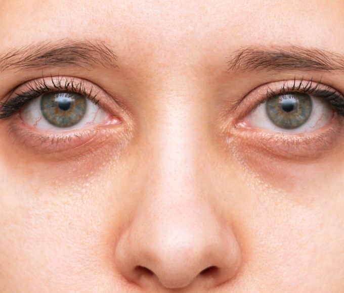 reduce dark circles and puffiness under your eyes